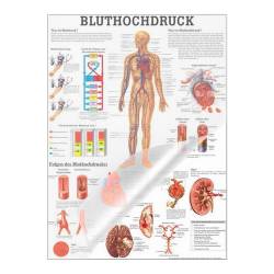 Bluthochdruck Bluthochdruck des Menschen | Poster 50 x 70 cm | laminiert